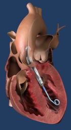 FDA grants breakthrough device designation to Impella ECP, the world’s smallest heart pump