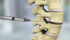 DiscGenics presents positive Phase1/2 study of Cell therapy for degenerative disc disease