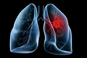 Early detection of lung cancer vital to combat rising mortality rate, says GlobalData