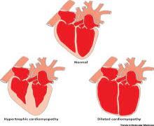 Global (68M) cardiomyopathies market set to reach $9.63 bn by 2031: GlobalData