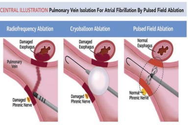 GlobalData predicts product cannibalization within electrophysiology ablation space